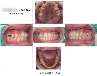 반대교합교정 & 청소년교정