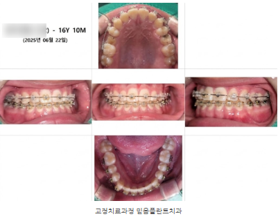 반대교합교정 & 청소년교정