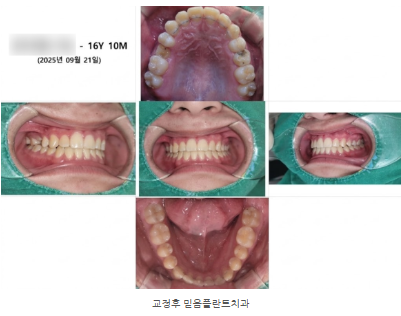 반대교합교정 & 청소년교정