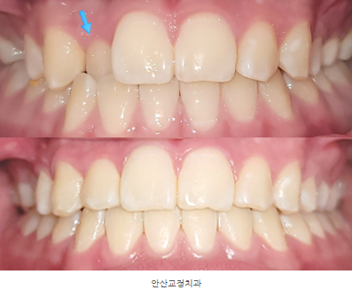 반대교합교정 & 청소년교정