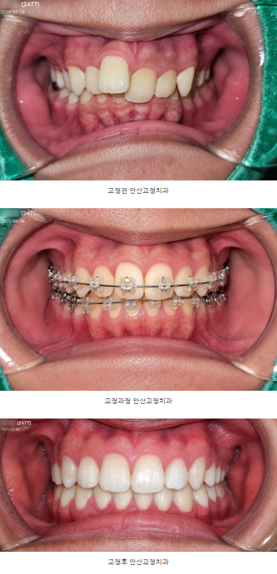 돌출된 앞니, 덧니, 교정, 안산 중앙동 교정치과