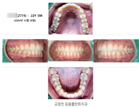 앞니 교정