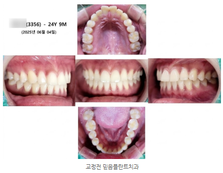 안산 라미네이트 치료 전 사진