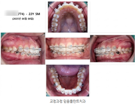 앞니 교정