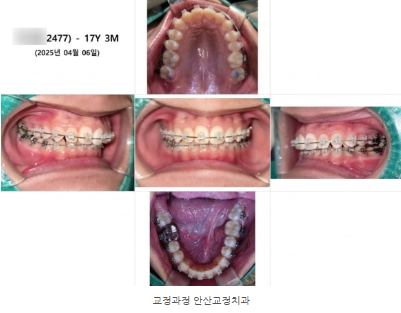 돌출된 앞니, 덧니, 교정, 안산 중앙동 교정치과