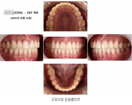 2개월 부분교정 진행 모습
