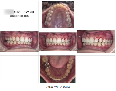 돌출된 앞니, 덧니, 교정, 안산 중앙동 교정치과