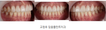 라미네이트 치료 후 자연스러운 앞니