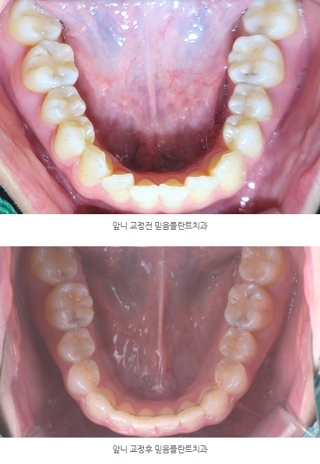 앞니 교정