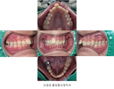 돌출된 앞니, 덧니, 교정, 안산 중앙동 교정치과