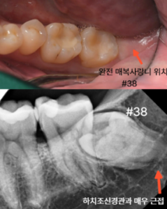 안산 사랑니 발치 사례