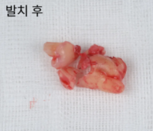 안산 사랑니 발치 사례