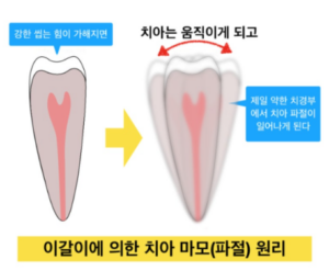 안산치과 믿음플란트 임플란트 사례