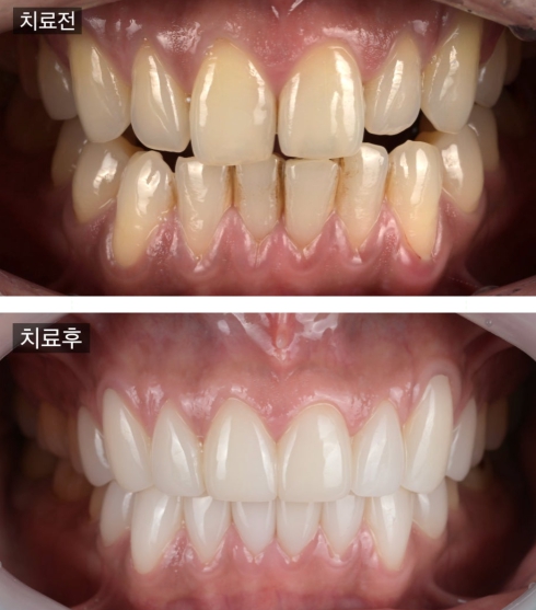 노랗게 변색된 치아, 무삭제 라미네이트 치료 안산 중앙동 치과