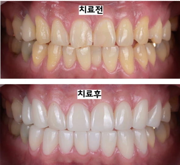 앞니 라미네이트로 치아 배열과 색상까지 개선한 심미치료 사례 안산 중앙동 믿음플란트치과