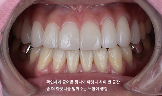 교정 후 치아색과 형태까지 라미네이트로 개선한 사례 중앙동치과