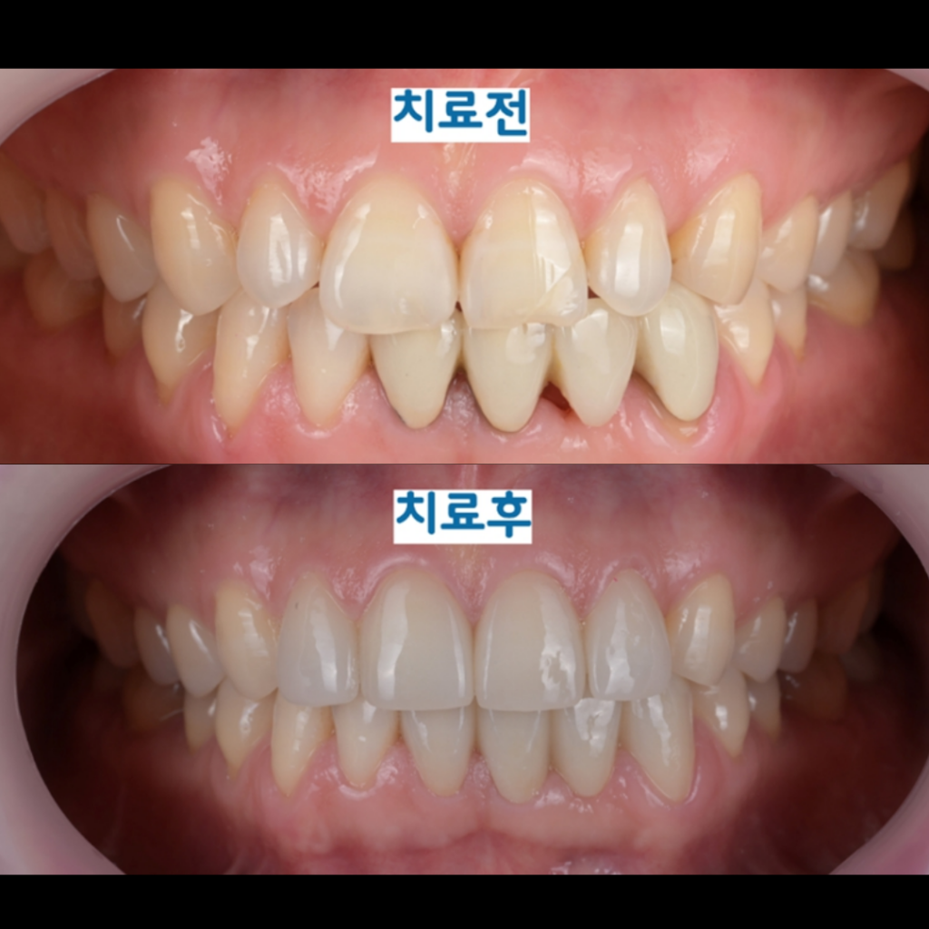 앞니 브릿지 교체와 무삭제 라미네이트로 전치부 심미 회복한 사례 안산 단원구 믿음플란트 치과