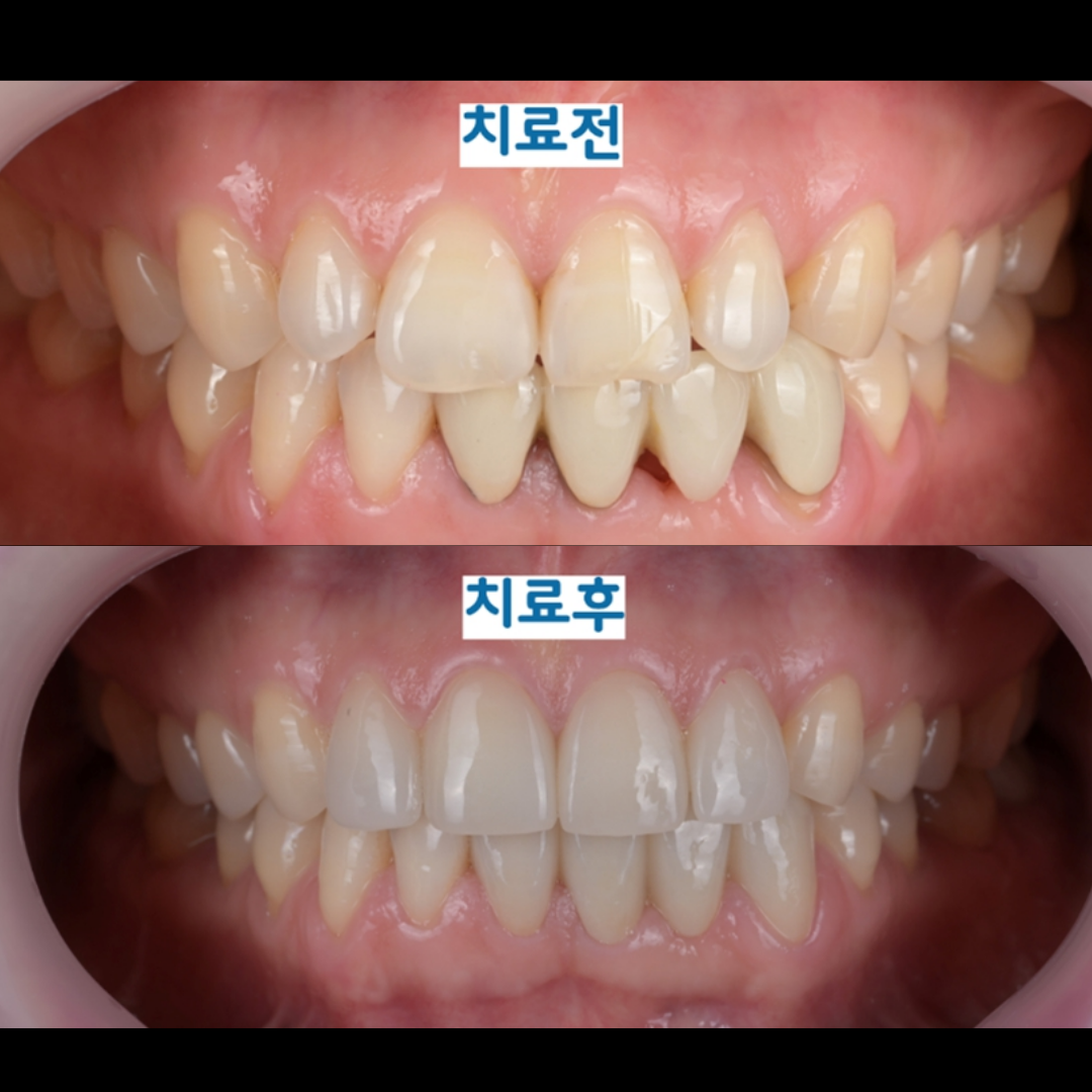 앞니 브릿지 교체와 무삭제 라미네이트로 전치부 심미 회복한 사례 안산 단원구 믿음플란트 치과