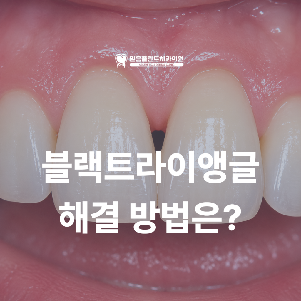블랙트라이앵글, 앞니 사이 검은 공간이 생기는 이유와 해결 방법