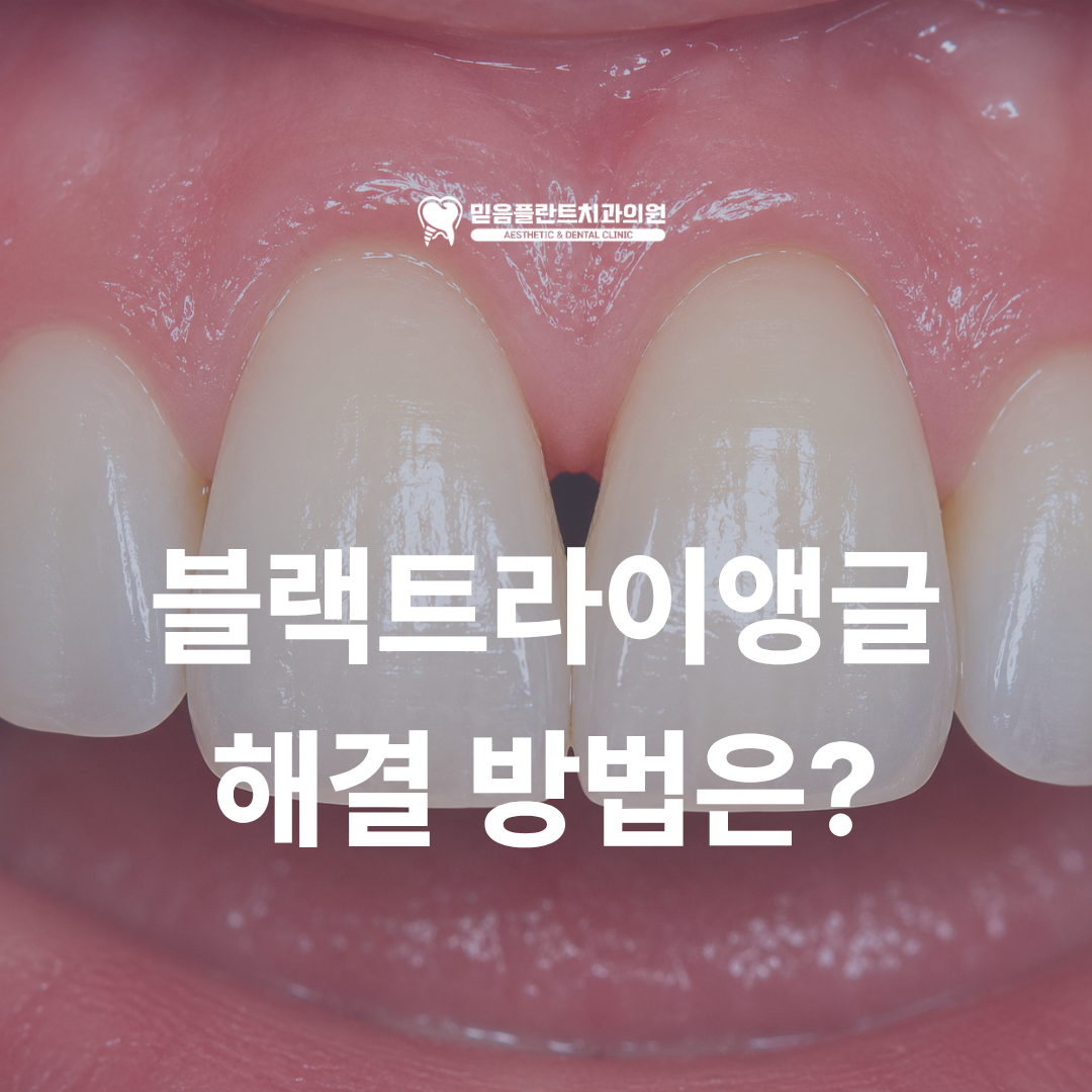 블랙트라이앵글, 앞니 사이 검은 공간이 생기는 이유와 해결 방법