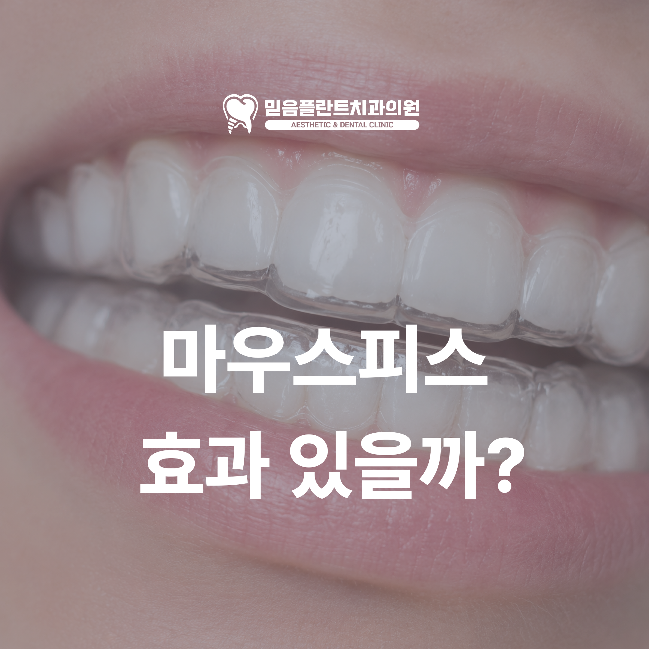 마우스피스 효과 있을까? 이갈이와 턱관절 통증 때문에 내원하시는 분들께