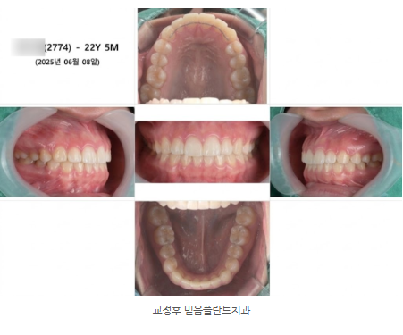 앞니 교정