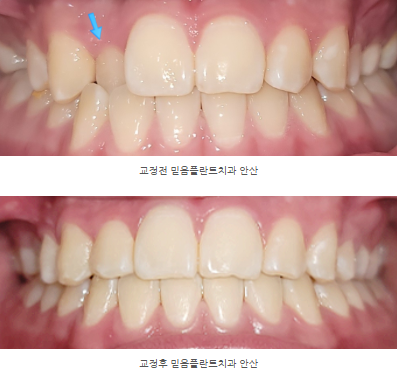 반대교합과 덧니, 임플란트까지 고려한 교정치료 사례 | 안산 중앙동 교정치과