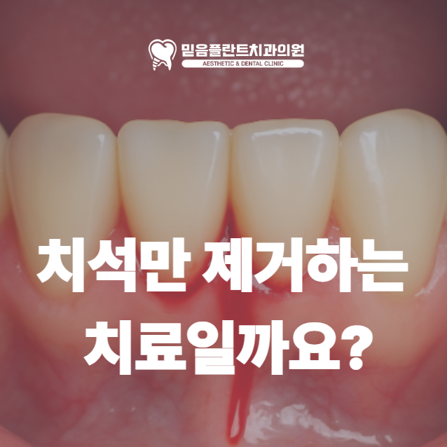 안산 스케일링, 치석만 제거하는 치료일까요? 잇몸병 예방을 위한 정기 스케일링의 중요성