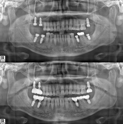 임플란트 식립 후 X-ray 또는 수술 사진