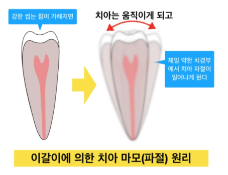 치경부 마모 설