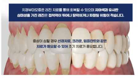 치경부 마모 