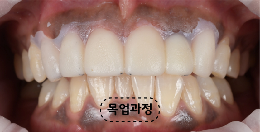 최종 보철물 제작 전 앞니의 길이와 형태 및 맞물림을 미리 확인한 목업 과정