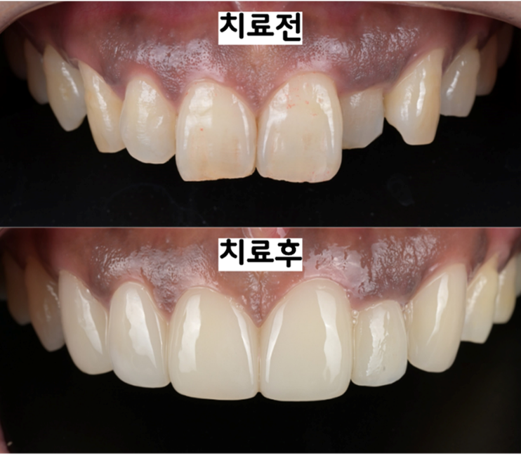 반대로 물리던 앞니를 라미네이트와 크라운으로 치료하기 전과 후의 정면 비교 사진