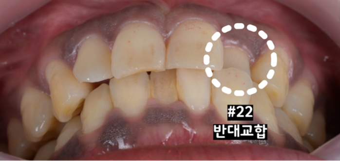 왼쪽 위 두 번째 앞니인 22번 치아가 아래 앞니 안쪽으로 반대로 물리는 치료 전 모습