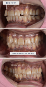 치아·잇몸 미백 후 앞니 상태을 보여주는 앞니 임상 사진