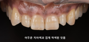 상악 1차 잇몸미백 과정을 보여주는 잇몸 임상 사진.