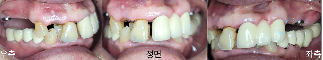 치료 전 우측·정면·좌측 구강사진