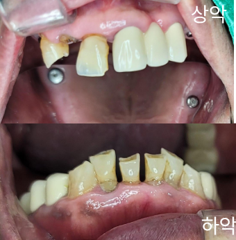 치료 전 상악·하악 구강사진