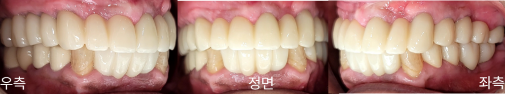 이가 잘 안 씹혀요, 무너진 교합을 다시 맞춘 전악 임플란트·보철 치료 사례 · 치료 후