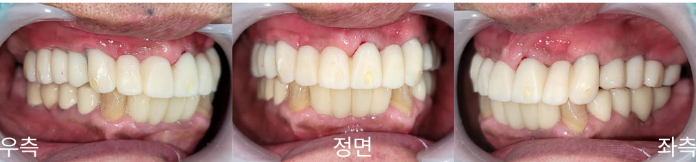 PMMA 임시치아 적용 후 구강사진