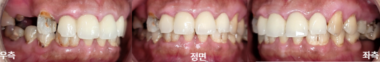 다수 치아 임플란트 치료 전 정면과 양측 구강사진