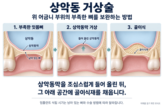 상악동 거상술 원리를 설명하는 AI 생성 이미지
