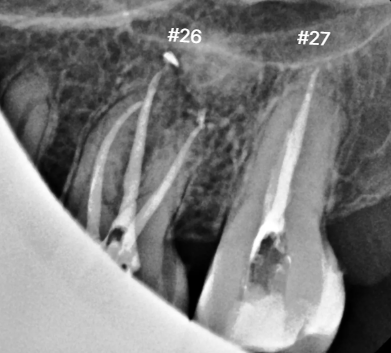 위 어금니 신경치료 후 | After molar root canal treatment | 믿음플란트 안산 믿음플란트 안산 왼쪽 위 큰어금니 26번과 27번 신경치료 후 치근단 방사선사진, After molar root canal treatment