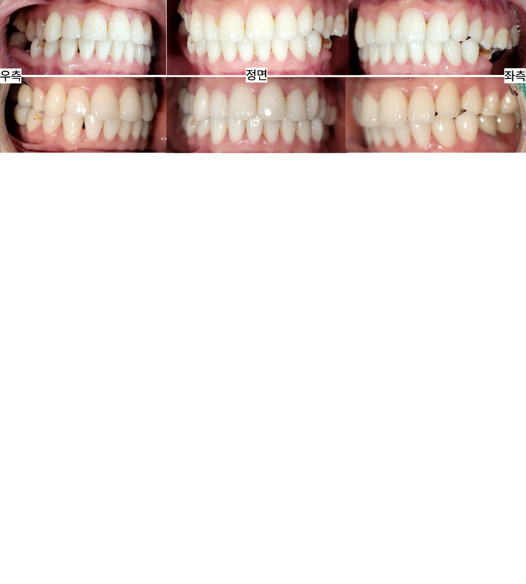 어금니 치료 전후 구강사진 | Before and after intraoral views | 믿음플란트 안산 믿음플란트 안산 어금니 임플란트·크라운 치료 전후 우측·정면·좌측 구강사진 비교, Before and after intraoral views