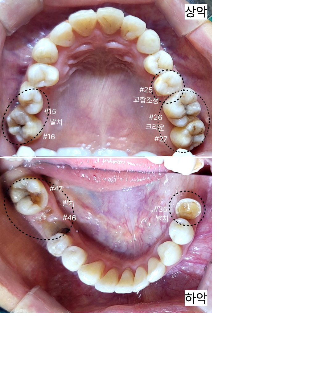 치료 전 상악·하악 | Before occlusal views | 믿음플란트 안산 믿음플란트 안산 임플란트 치료 전 위턱과 아래턱의 어금니 결손 및 치아 상태, Before occlusal views