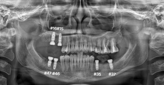 임플란트 식립 후 파노라마 | After implant placement | 믿음플란트 안산 믿음플란트 안산 위아래 어금니 임플란트 식립 후 위치를 확인한 파노라마, After implant placement